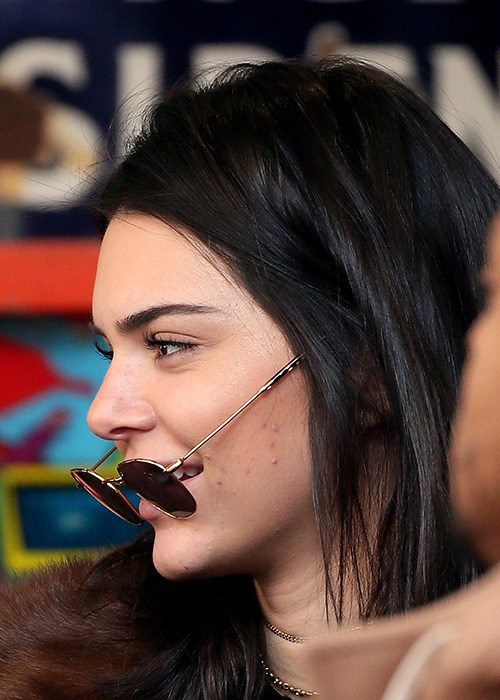 Kendall Jenner acne